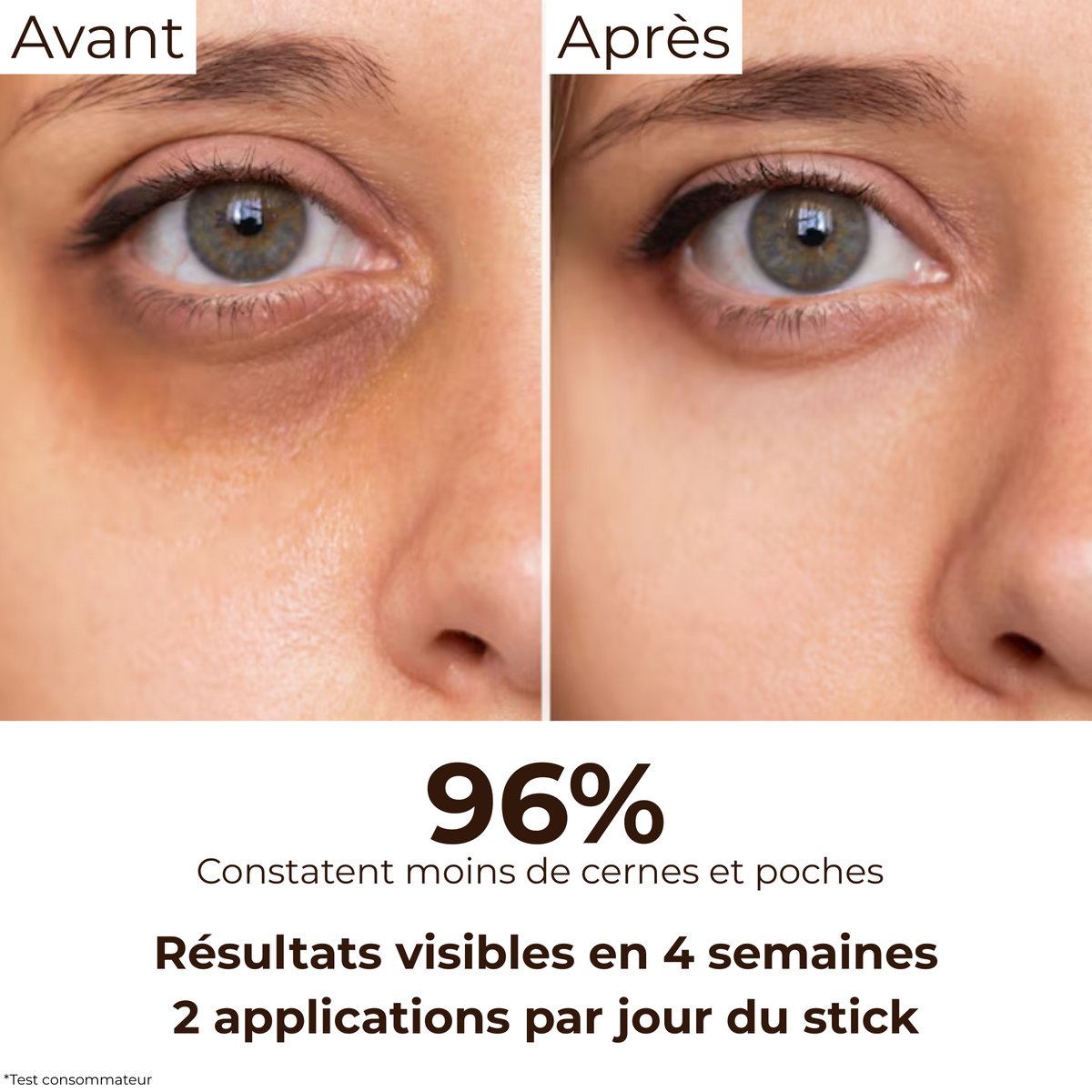 Comparatif Avant/Après : atténuation visible des cernes foncés après 4 semaines avec le stick anti-cernes à la caféine Enkrem, 96% d’utilisatrices satisfaites.