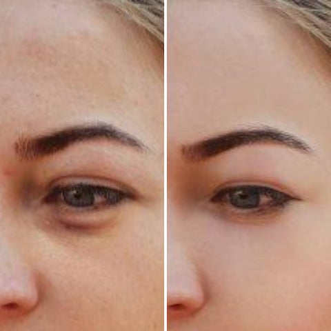 Comparatif avant-après illustrant la réduction des poches sous les yeux grâce au stick anti-cernes à la caféine Enkrem