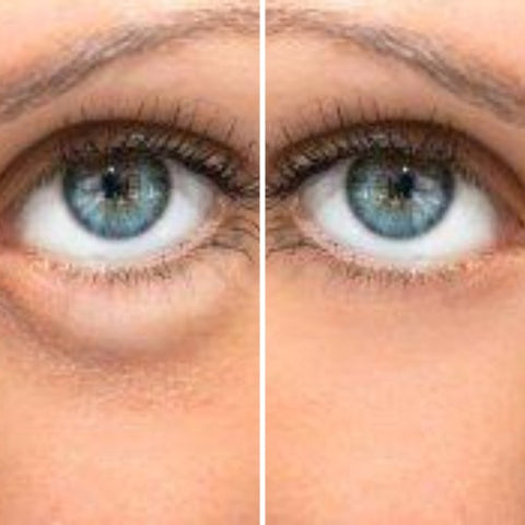 Avant-après montrant la diminution visible des poches sous les yeux après utilisation du stick anti-cernes à la caféine Enkrem