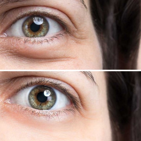 Avant-après montrant la diminution visible des poches sous les yeux après 4 semaines d’utilisation du stick anti-cernes à la caféine Enkrem