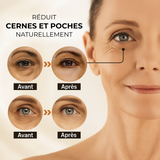Comparatif avant-après sur plusieurs femmes montrant les effets du stick anti-cernes à la caféine Enkrem sur les cernes et poches sous les yeux