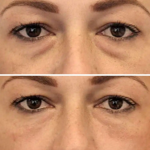Image illustrant des cernes marqués sous les yeux, zone ciblée par le stick anti-cernes à la caféine Enkrem pour un regard reposé